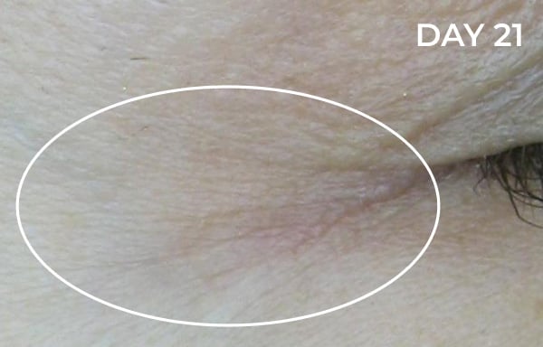 Reduction in nasolabial fold after