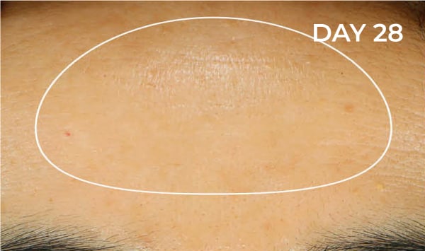 Reduction in forehead area after