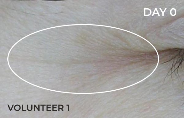 Reduction in nasolabial fold after