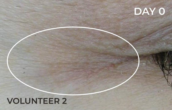 Reduction in nasolabial fold after