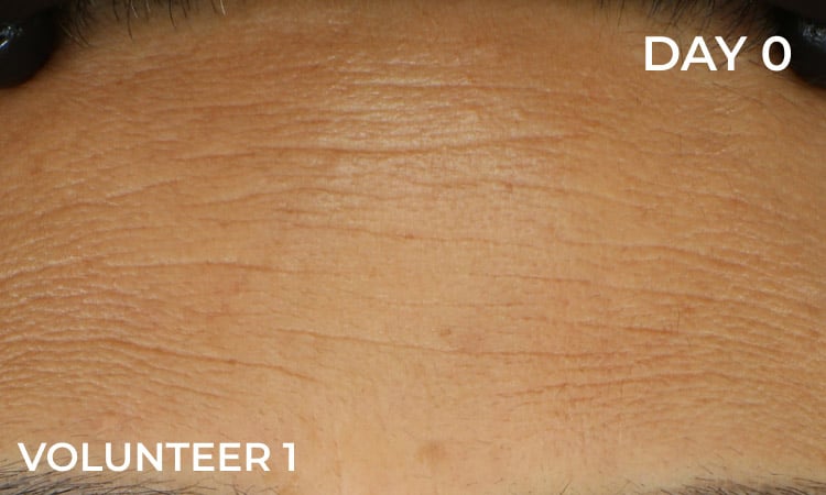 Reduction in forehead wrinkles before