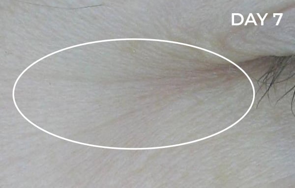 Reduction in nasolabial fold after