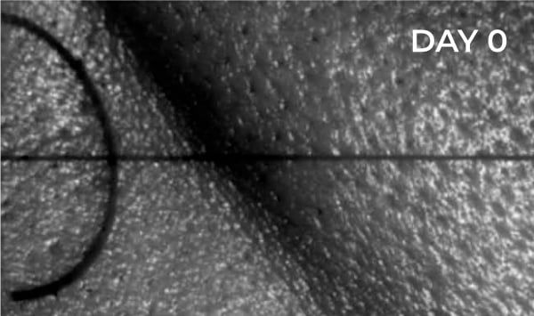 Reduction in nasolabial fold before