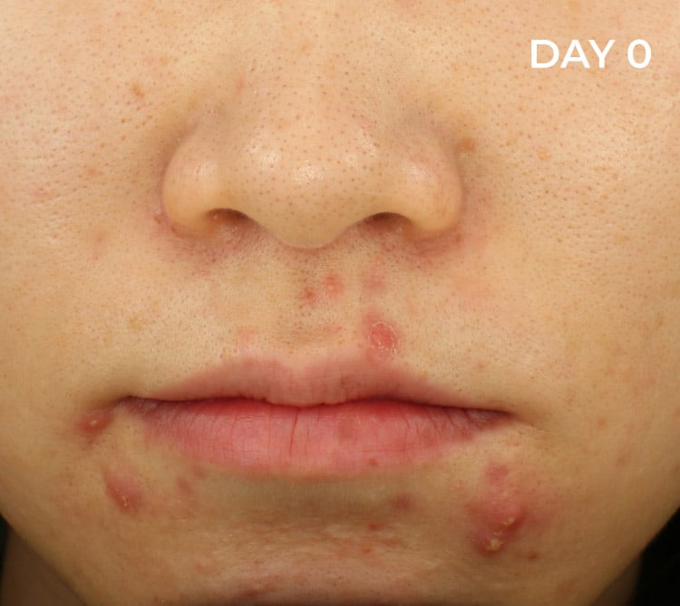 Reduction of blemishes before