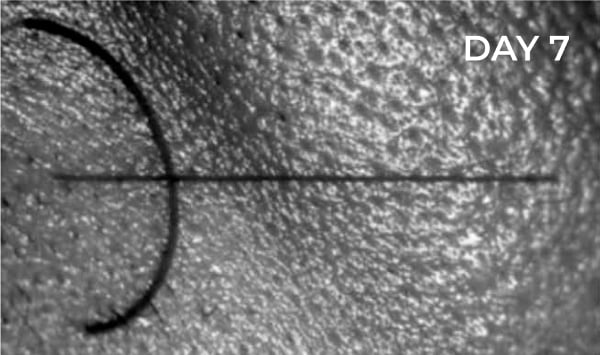 Reduction in nasolabial fold after