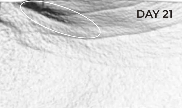 Reduction in eye contour area after