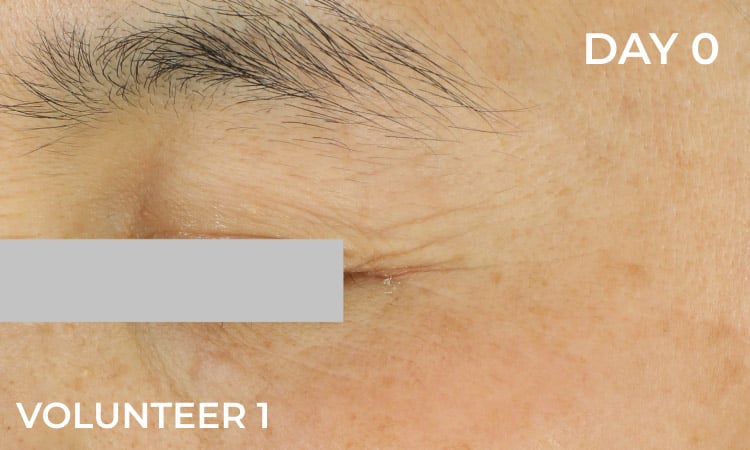 Reduction in eye wrinkles before