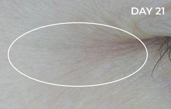 Reduction in nasolabial fold after